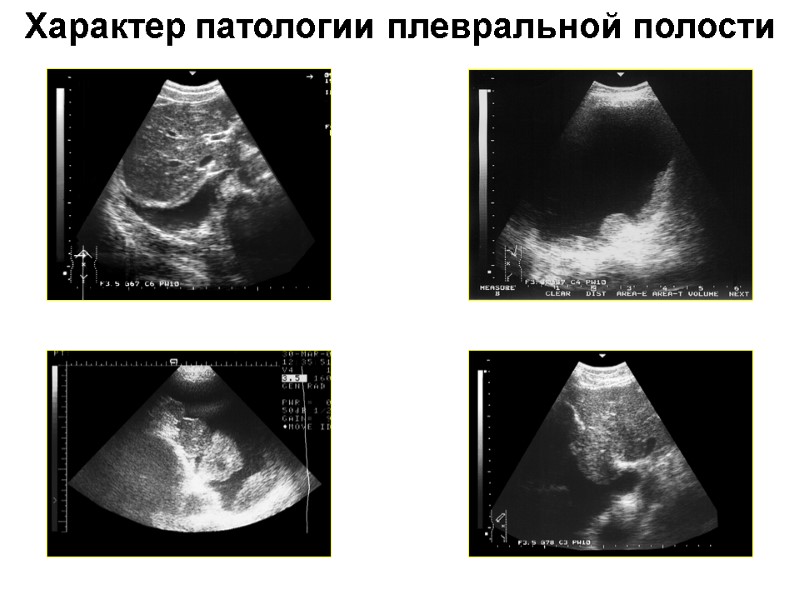 Характер патологии плевральной полости